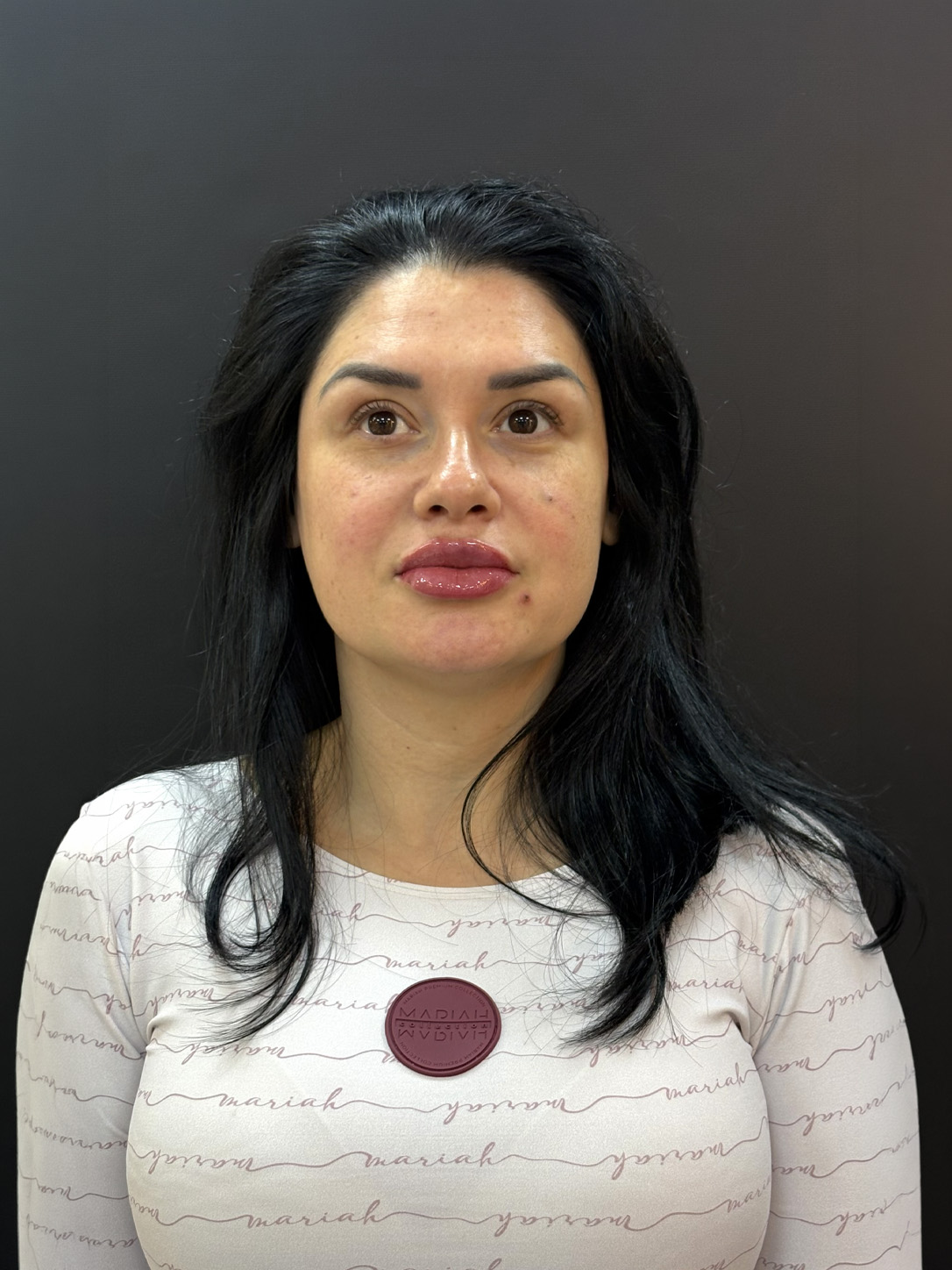 Rosto após harmonização facial, com contornos mais definidos e resultado natural